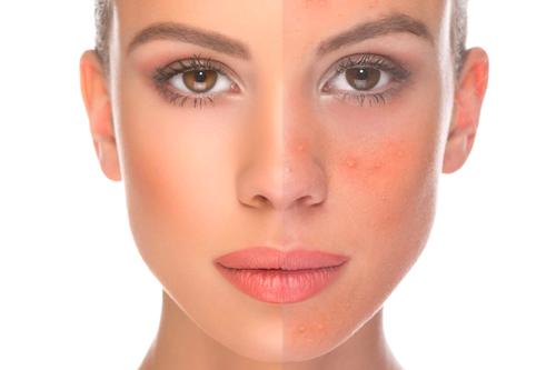 Rosacea / Cuperose